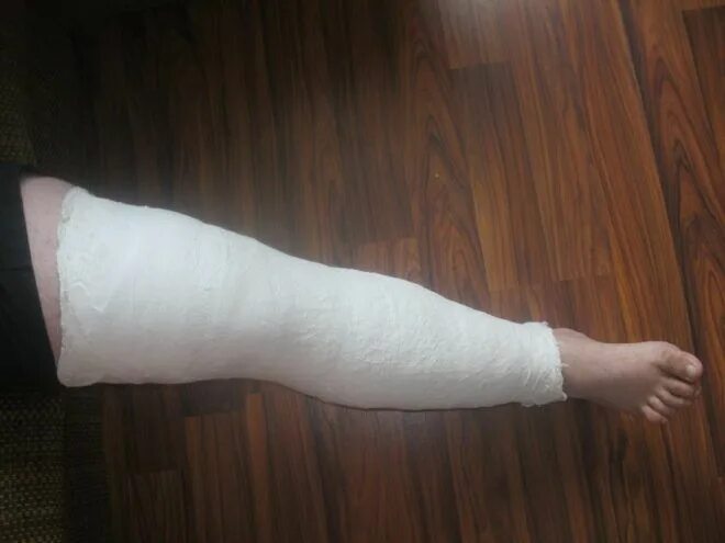 гипс на коленный сустав. гипс на коленный сустав. ортез для перелома колена. эластичный бинт на ногу. тутор послеоперационный knee ranger 79-94040.