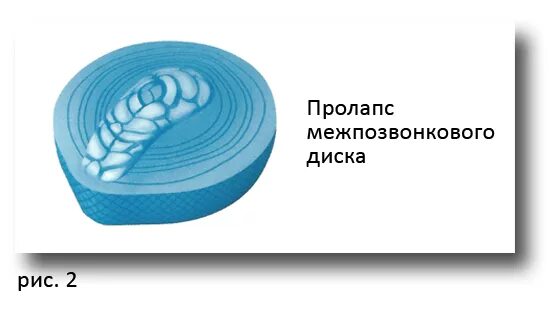 Пролабирование позвоночного диска. Пролапс межпозвоночного диска. пролабирование межпозвоночного диска. пролабирование дисков позвоночника что это такое. пролапс диска позвоночника что это.