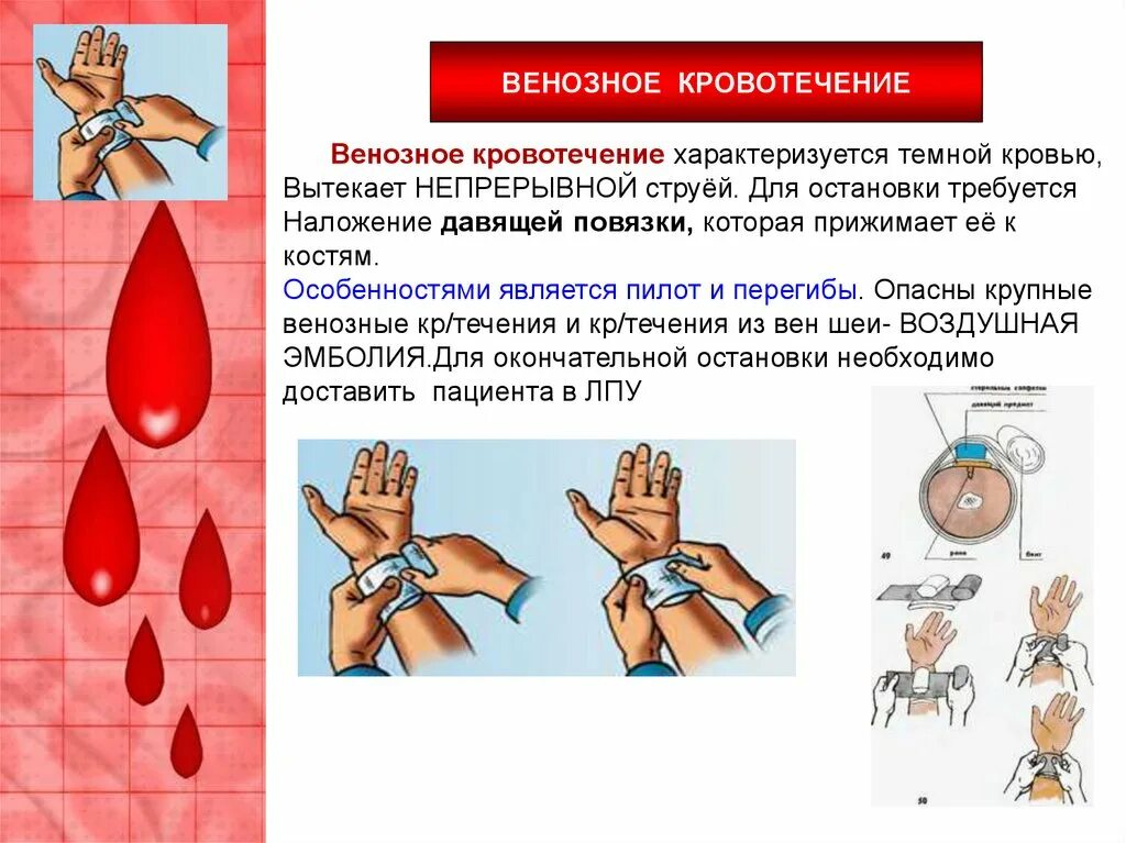 Выберите примеры которые характеризуют венозное кровотечение Венозное кровотечение