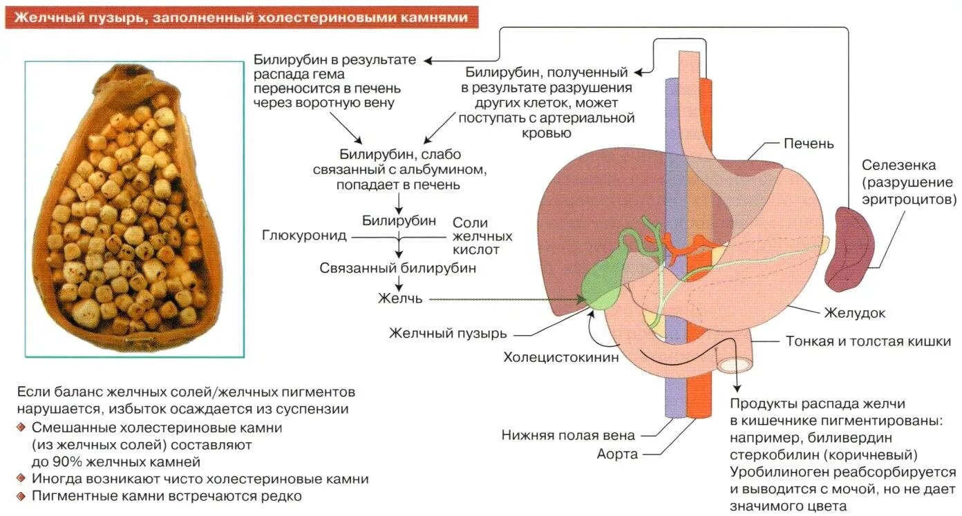 Обработка пищевого комка желчью. Удаляются ли камни желчного пузыря. Диета при камнях в желчном пузыре. Образование желчных камней.