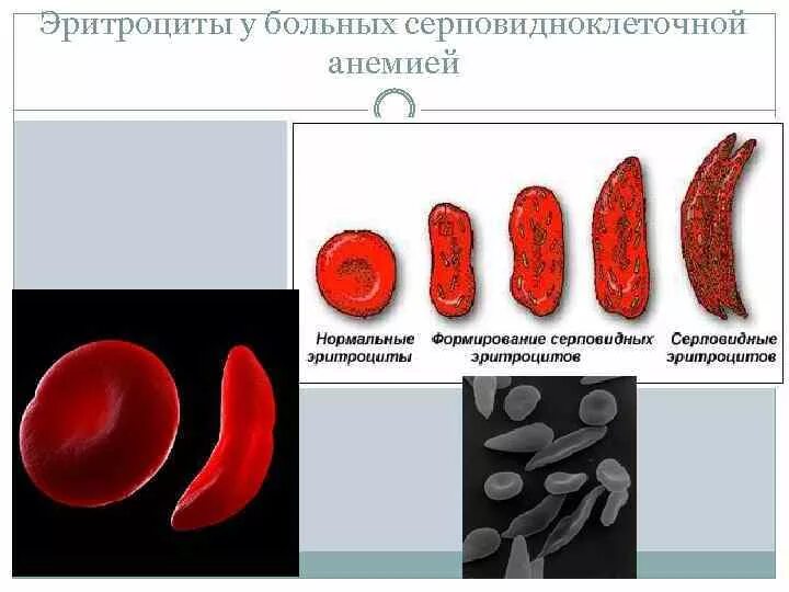 Серповидноклеточная анемия кариотип больного. Серповидноклеточная анемия Тип наследования. Гемоглобин серповидноклеточная анемия. Гемоглобин s при серповидноклеточной анемии.