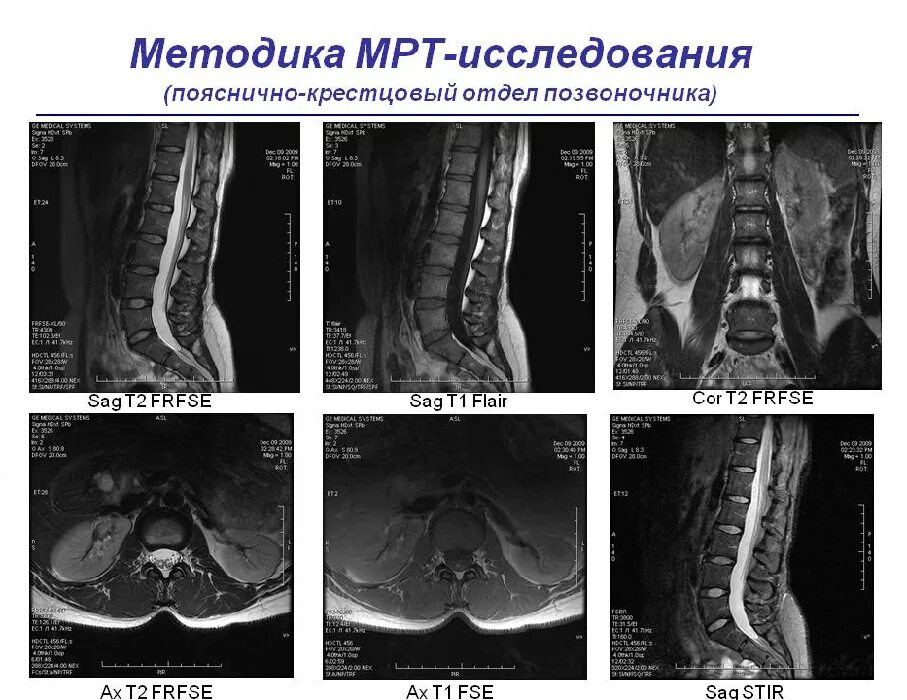 Мрт спинного отдела. Мрт позвоночника пояснично-крестцового отдела (l1-s1). Мрт расшифровка снимков поясничного отдела. Мрт пояснично-крестцового отдела норма. Мрт 1.5 пояснично-крестцового отдела позвоночника.