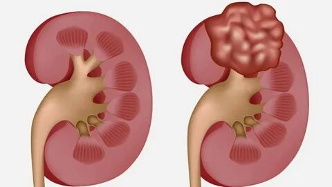 TUMORES RENALES - YouTube