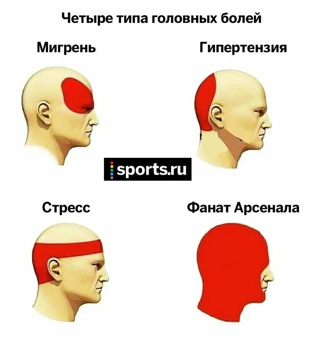 Болит лоб часть головы. Разновидности головной боли. Боль в затылочной части головы. Виды головной боли затылок. Болит голова в затылочной части.