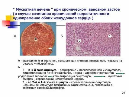 Причины фиброза печени
