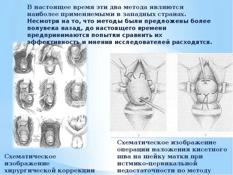 Наложение шва шейки при беременности. Круговой шов на шейку матки. Наложили швы на шейку матки. Шов шейки матки при беременности. Швы при ицн