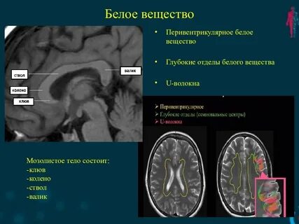 Лейкоареоз головного мозга что это