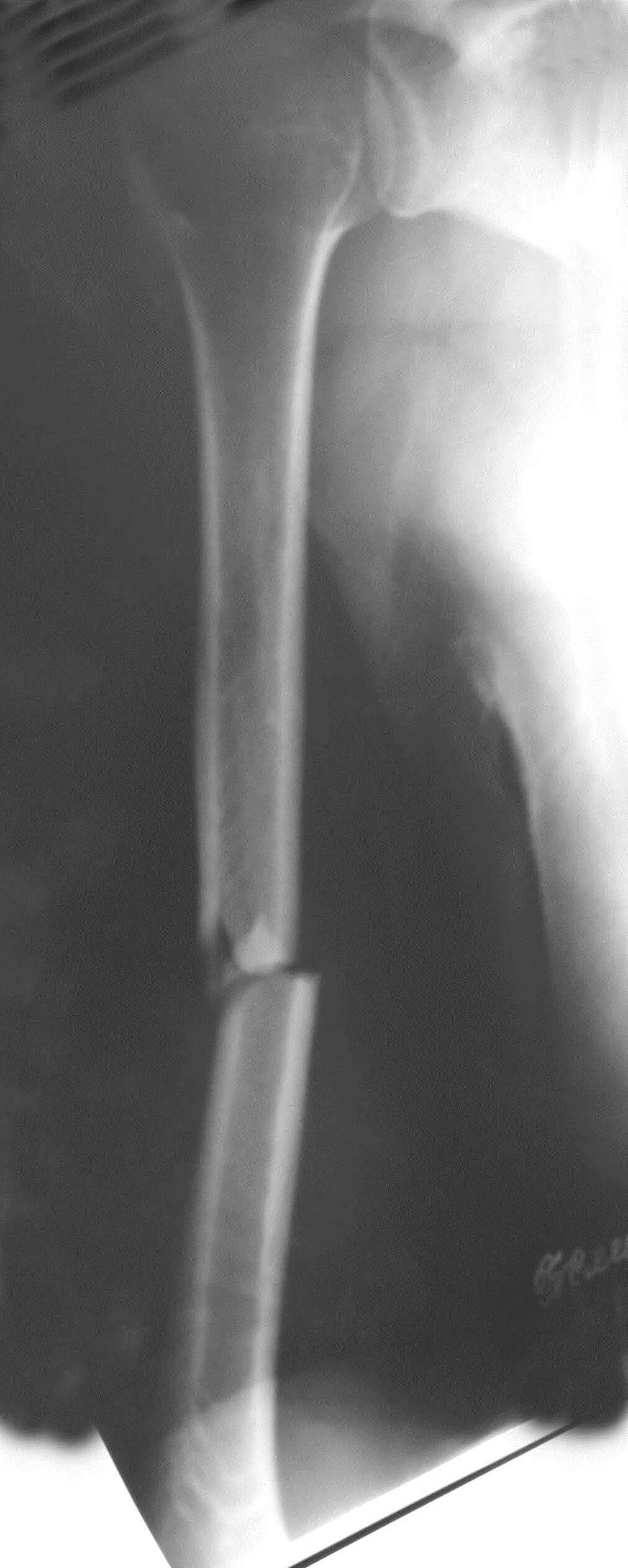 Оскольчатый винтообразный перелом плечевой кости. Поперечный перелом плечевой кости абдукционный. Осколочный перелом плечевой кости. Субкапитальный перелом плечевой кости. Чрезмыщелковый перелом плечевой кости.