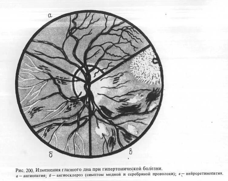 Болезнь глазного дна. Эмболия артерии сетчатки. Ангиопатия сетчатки глазное дно. Исследование глазного дна при артериальной гипертензии. Офтальмоскопия глазного дна при гипертонической болезни.