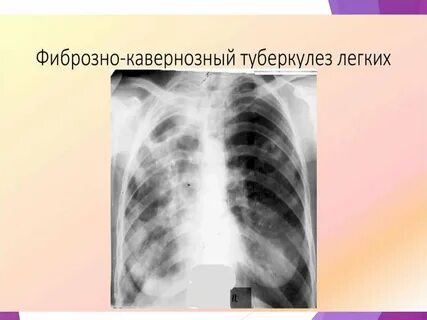 Фиброзно кавернозный туберкулез