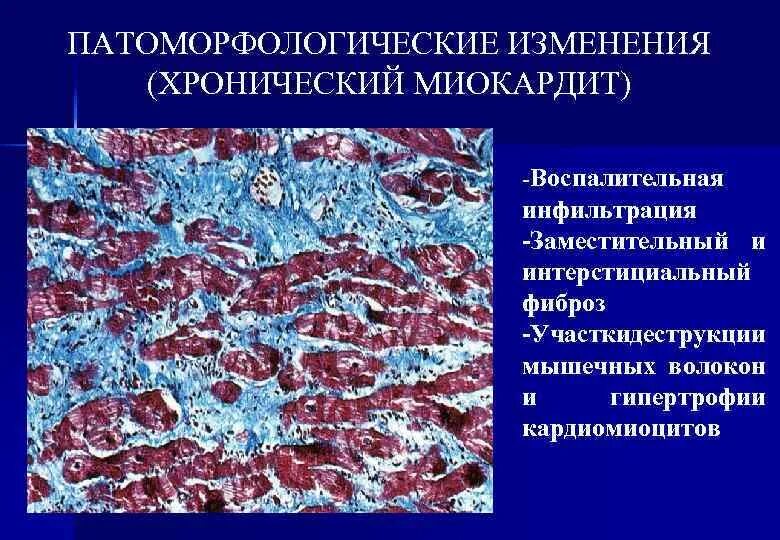 Хронический лимфолейкоз микропрепарат селезенки. Гидропическая дистрофия печени. Инфильтрация это в патологии. Инфильтрация данных. Синдром крупноочагового уплотнения легочной ткани.