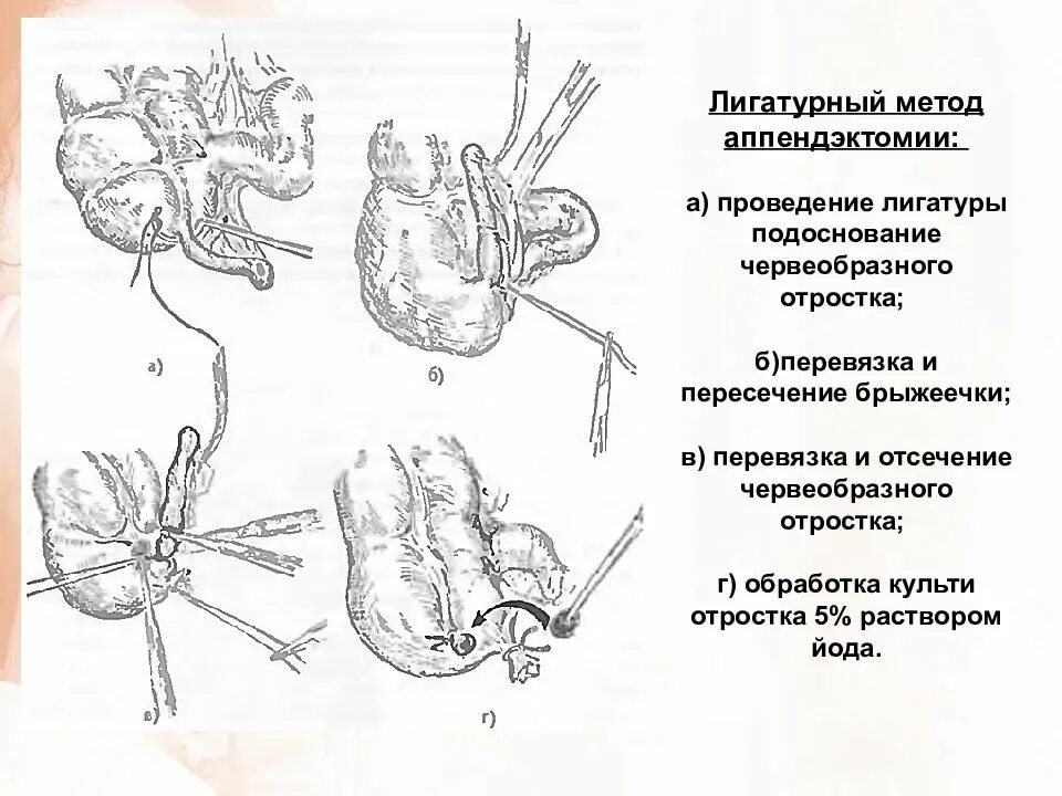 Антибиотики после аппендицита. Лапароскопическая аппендицит аппендэктомия. Аппендэктомия способы обработки культи червеобразного отростка. Антеградная лапароскопическая аппендэктомия. Тракция червеобразного отростка.