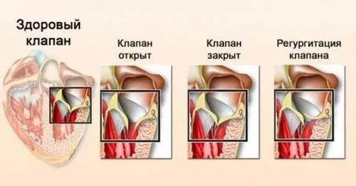 Пмк 2 степени. Пролапс митрального клапана 1 степени. проляпс митральногоклапана 1степени. пролапс передней створки митрального клапана. пролабирование створок митрального клапана 1.