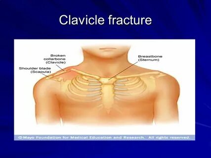 Fractured collarbone