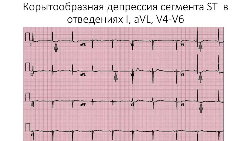 Мв на экг. Депрессия St в отведениях v6. Косонисходящая депрессия сегмента St. Депрессия St v4-v6 ЭКГ. Кардиограмма депрессия сегмента St.