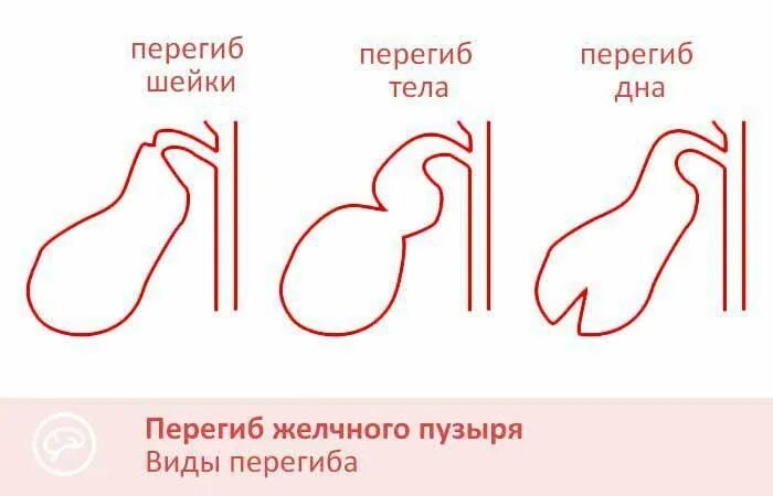 Перегиб желчного пузыря у женщины. Желчный пузырь с перегибами в области шейки и тела. перегиб желчного пузыря в области шейки тела ,дна. изогнутая форма желчного пузыря. форма желчного пузыря с перегибом.