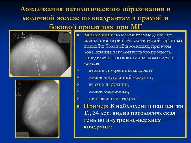 Округлые образования в молочной железе