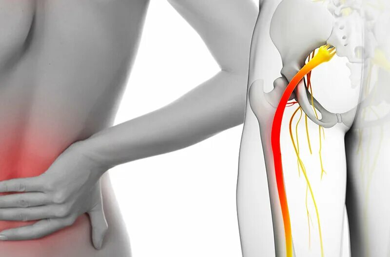 Боль в пояснице защемление седалищного. Ишиас воспаление седалищного. Седалищный нерв позвонки. Ишиас - защемление седалищного нерва.