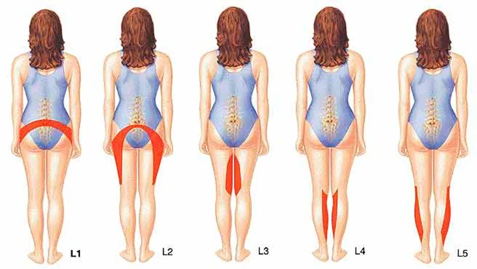 Болят ноги и поясница у женщины причины. Пояснично-крестцовый отдел позвоночника l5 s1. Гимнастика при протрузии l5-s1. Протрузия l5 s1 симптомы. Грыжа диска l5-s1 симптомы.