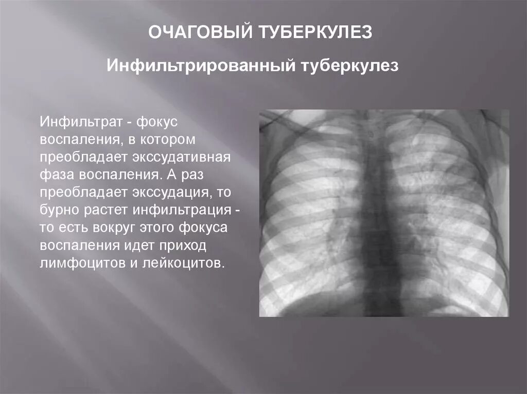 Очаговая форма туберкулеза. Хронический очаговый туберкулез. Фиброзно очаговый туберкулез. Очаговый туберкулез инфильтрации. Формы очагового туберкулеза.