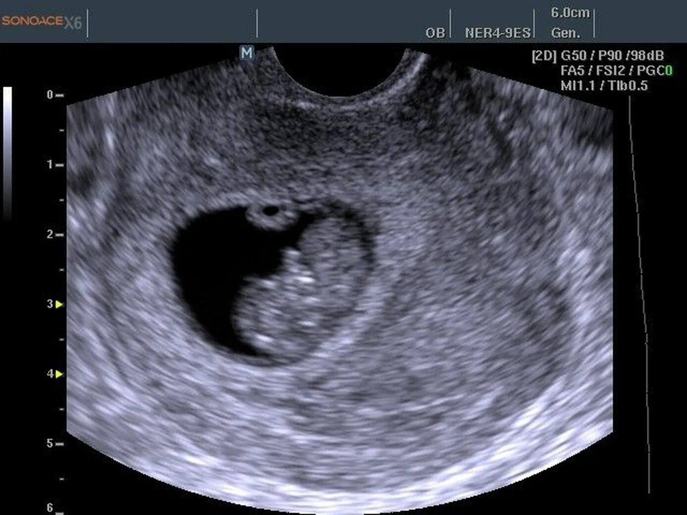 Эмбрион на 8 неделе беременности УЗИ. Фото УЗИ плода на 8 акушерской неделе беременности.