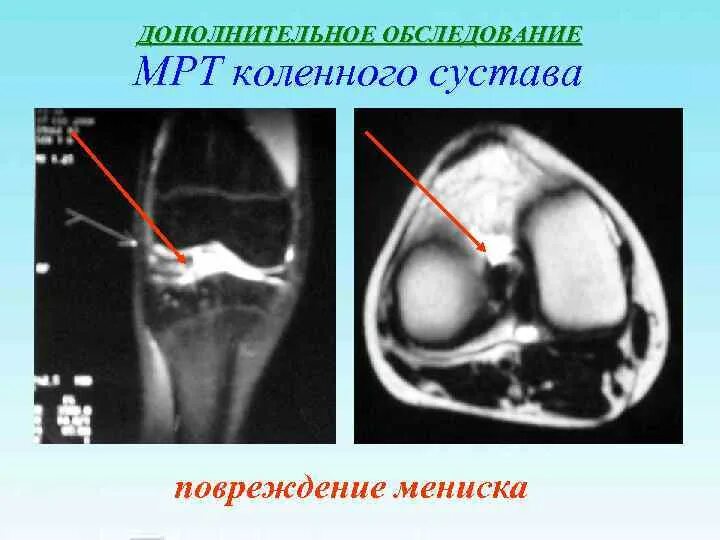 Травма мениска коленного сустава мрт. Повреждение мениска коленного сустава мрт. Мрт коленного сустава разрыв мениска.