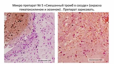 Тромбоз патанатомия