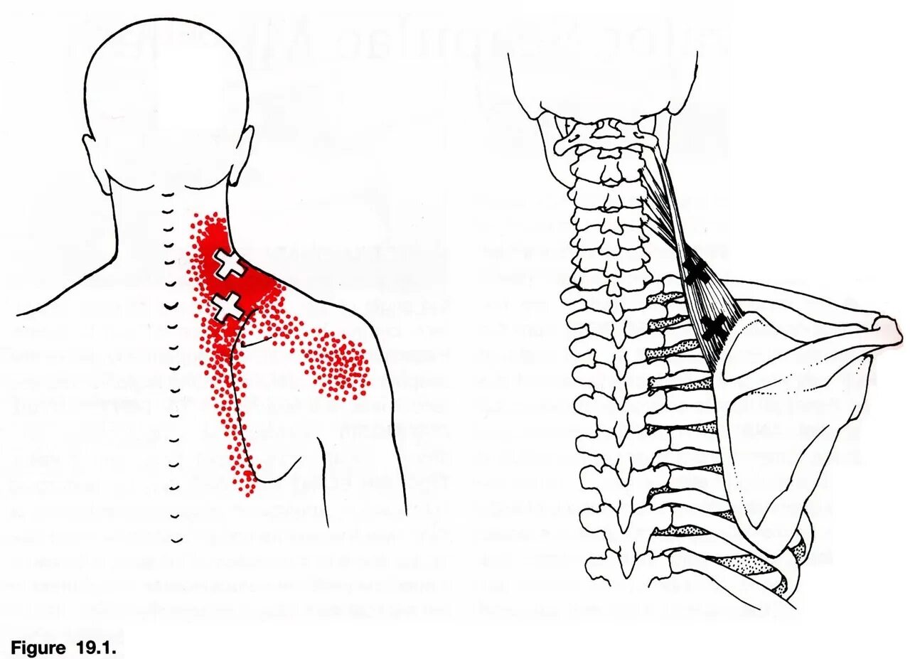 Болит плечо отдает в голову. Мышца поднимающая лопатку триггерные точки. Ременная мышца шеи триггерные точки. Ременная мышца головы триггерные точки. Миофасциальный синдром триггерные точки спины.