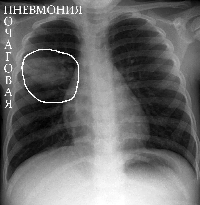 Болезни легких у детей