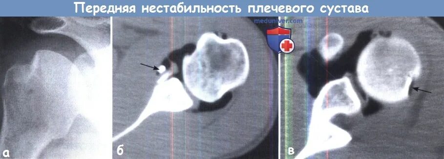 Нестабильность плечевого сустава мкб. Нестабильность плечевого сустава мкб
