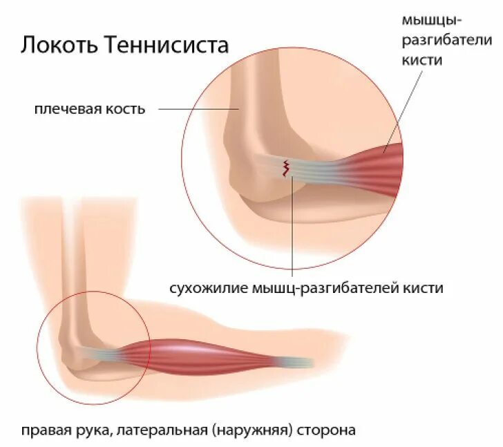 Боль в локтевом суставе при движении