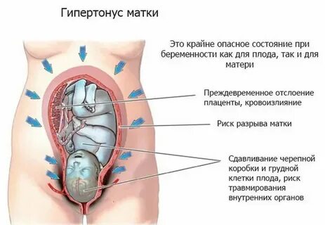 Симптомы тонуса матки
