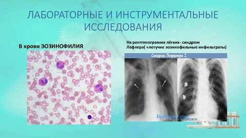 Диагноз инфильтрация легких