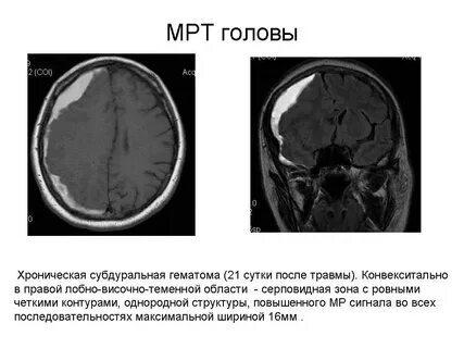 Гематома мрт