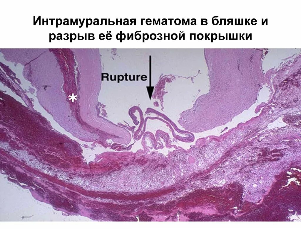Разрыв бляшки. Отрыв атеросклеротической бляшки. Атеросклероз аорты микропрепарат. Атеросклероз артерии микропрепарат. Интрамуральная гематома.