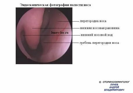Коагуляция носовых раковин