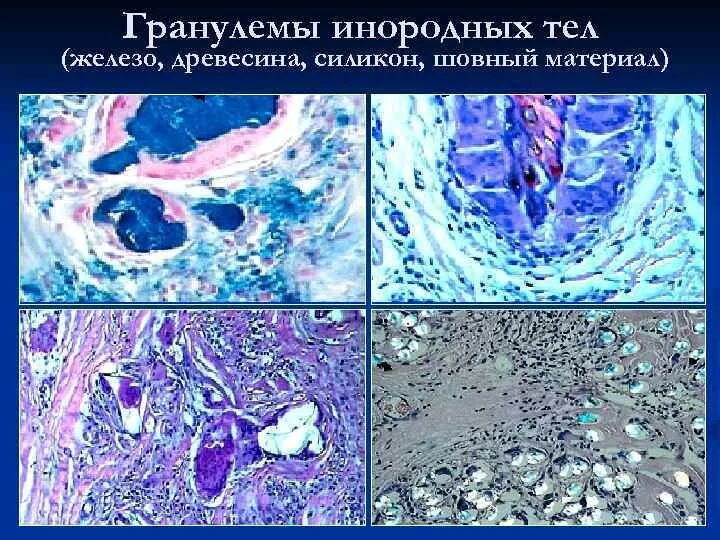Клетка типа инородных тел. Гигантоклеточная гранулема гистология. гранулема инородных тел патанатомия. гранулематозное воспаление патанатомия.