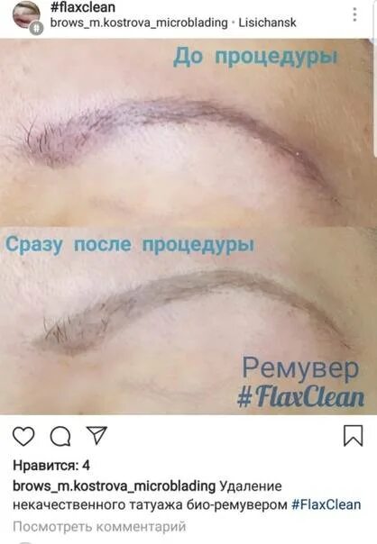 Можно после татуажа идти в баню. Брови после процедуры ремувером. ремувер сразу после процедуры. удаление татуажа корректором. последствия удаления татуажа ремувером.