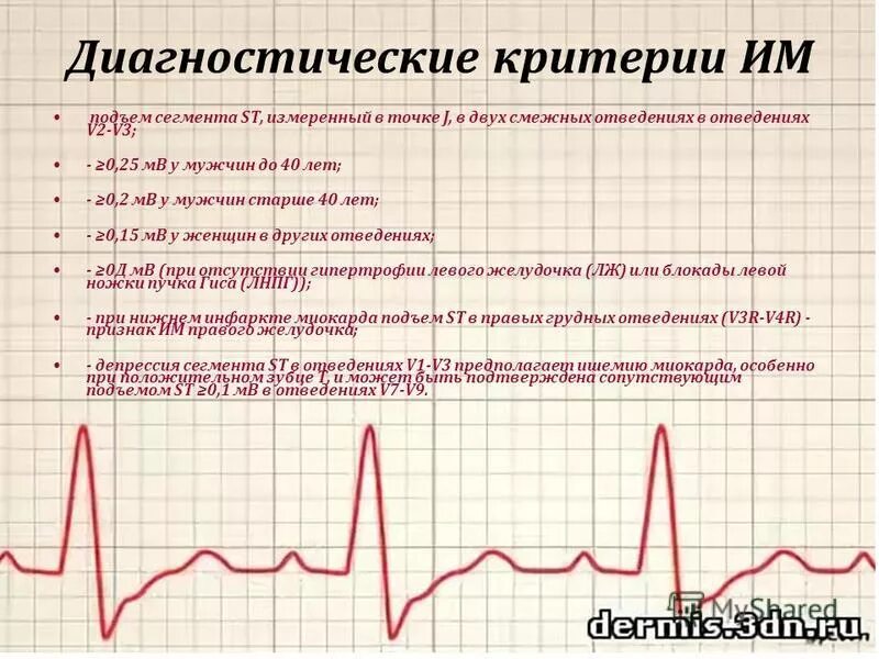 Подъем сегмента St. Подъем ст на ЭКГ. Им с подъемом сегмента St ЭКГ. Подъем сегмента St на ЭКГ. Мв на экг