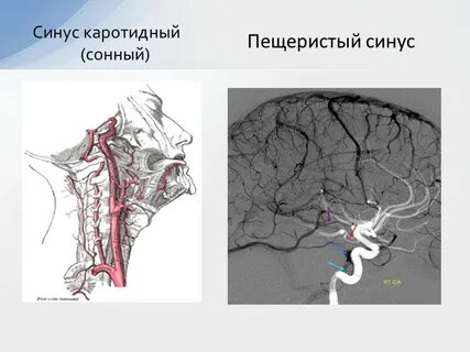 Каротидный синус