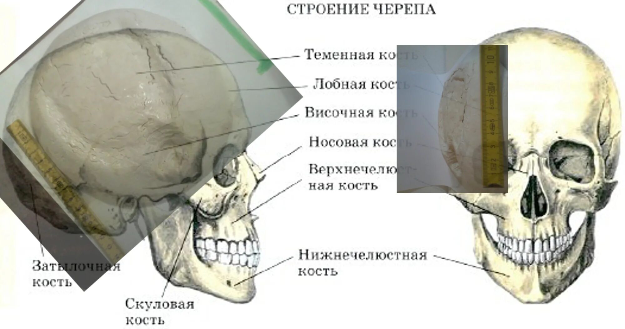 Перелом лицевого отдела черепа. Вдавленный перелом черепа. Скуловая кость анатомия. Неправильное строение черепа.