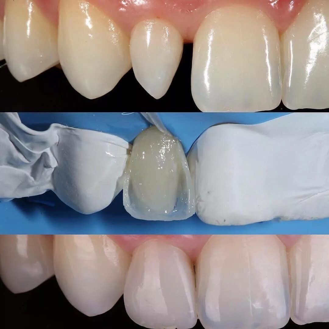 Типы реставраций. Композитные виниры Эстелайт. Восстановление фронтальных зубов. Художественное восстановление зубов. Наращивание зубов композитными материалами.