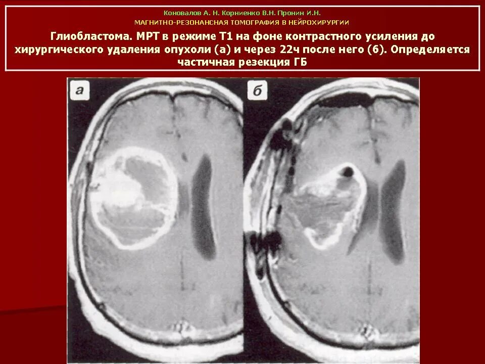 Глиобластома прогноз после удаления. Мультиполярная глиобластома 4 степени. Глиобластома прогноз после удаления. Глиобластома головного мозга продолжительность жизни. Глиобластома звездчатая.