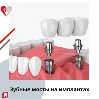 Мост на имплантах отзывы