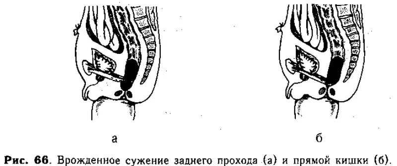 Стеноз кишечника что это. Врожденные сужения прямой кишки. Врожденные сужения заднего прохода и прямой кишки. Врожденное сужение заднепроходного отверстия. Сужение прохода прямой кишки.