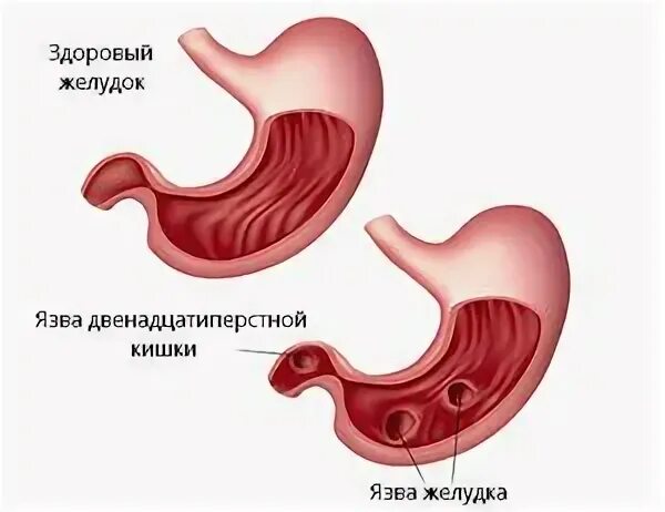 Прободная язва желудка и двенадцатиперстной кишки