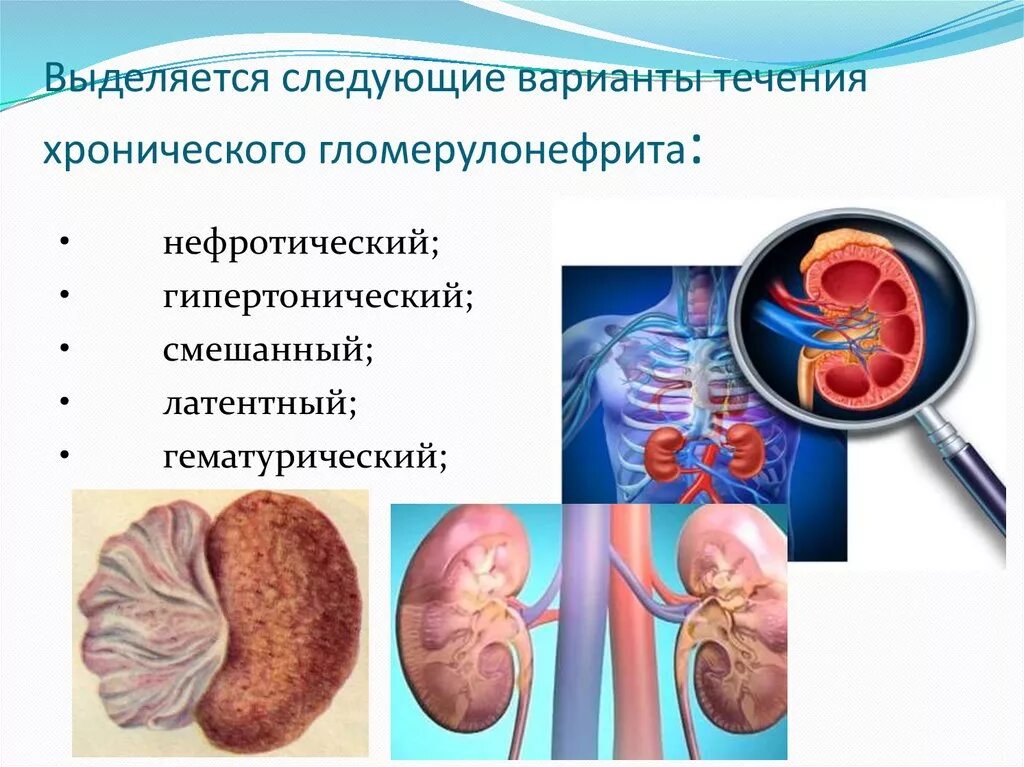 Латентный гломерулонефрит. Гломерулонефрит характеризуется воспалением. Осложнения острого пиелонефрита. Хронический гломерулонефрит и мочекаменная болезнь.