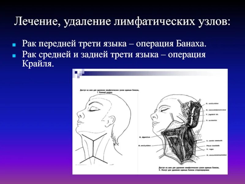 Операция лимфатические узлы. Операция Ванаха и Крайля. Операция Крайля ход операции. Шейная лимфаденэктомия операция Ванаха.