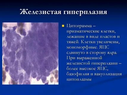 Пролиферация железистого эпителия nilm
