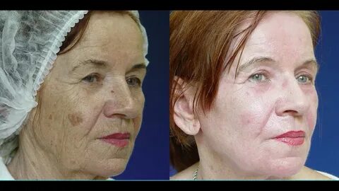 Лазерная шлифовка кожи skinlift